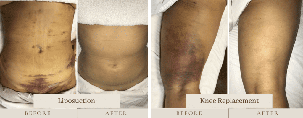 Before and After Lymphatic Massage for Liposuction and Knee Replacement
