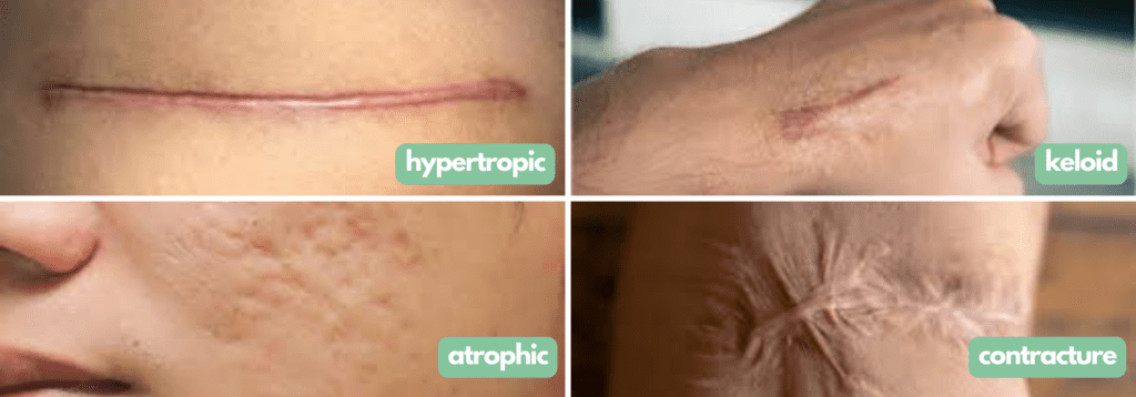 Types of Scar Tissue Hypertrophic | Keloid | Atrophic | Contracture